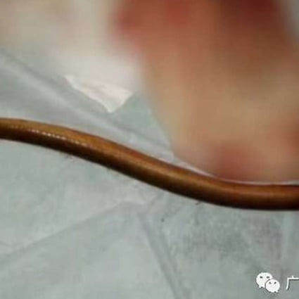 Doctors removed the live eel from the patient’s stomach. Photo: Handout