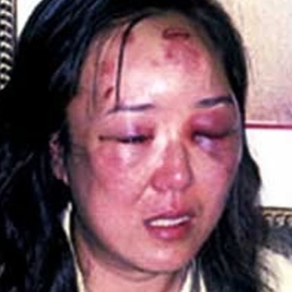 Tianjin businesswoman Zhao Yan displays the injuries she received at the hands of a US border agent in 2004. Photo: Xinhua