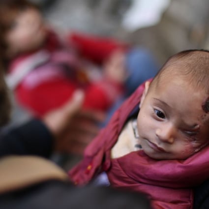 A picture taken on December 4 shows Syrian baby Karim Abdallah who lost his left eye and his mother in government shelling on the town of Hammuriya. Photo: Agence France-Presse