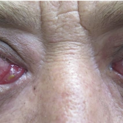 A patient with acute thyroid eye disease.