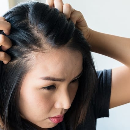 Hair loss: its causes, how to head it off and where to look for help when you can't stop thinning hair | South China Morning Post Hair loss: its causes, how to head it off and where to look for help when you can't stop thinning hair | South China Morning Post