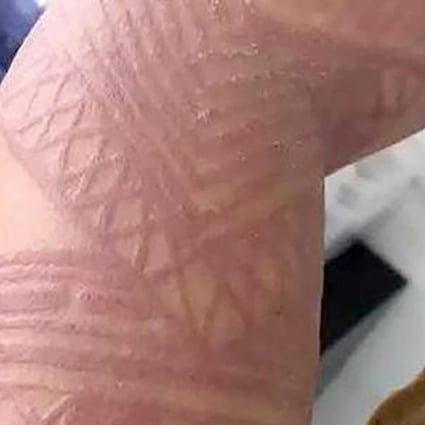 The 30-year-old tourist suffered a severe allergic reaction to his temporary body art. Source: thecover.cn