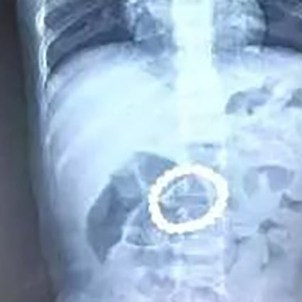 Surgeons at Beijing Children’s Hospital removed a ring of 21 magnetic balls from a toddler’s stomach. Photo: Weibo