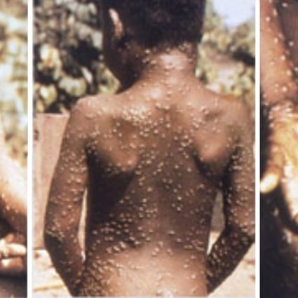 Rare Monkeypox Virus Sickens Two In Britain After They Separately Travelled To Nigeria South China Morning Post