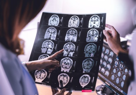 It can be daunting to get a brain scan to test for signs of dementia, but a neurologist behind new research reveals the advantages of knowing early. Photo: Shutterstock