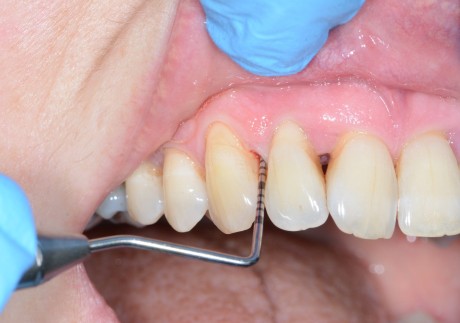 Bad dental hygiene could affect your mental health in the future, according to a study that says the risk of Alzheimer’s is 21 per cent higher in people with poor hygiene and gum disease. Photo: Professor Nicola West